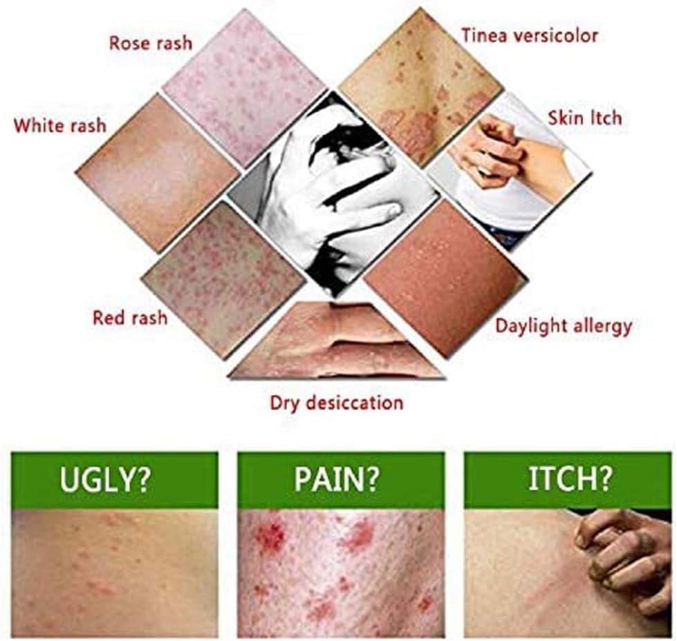 Chinese Herbal Eczema Cream, Anti-Itch, Psoriasis, Dermatitis and Pruritus Psoriasis, Natural Herbal Chinese Eczema Cream for Adults Kids (4PCS) - OutsideCool