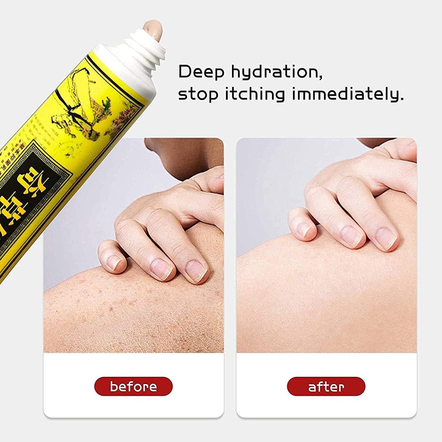 6 Pcs Eczema, Psoriasis, Anti-Itch Cream External Use Only, Dermatitis,Inflammation and Rashes, Anti Itch Cream Extra Strength