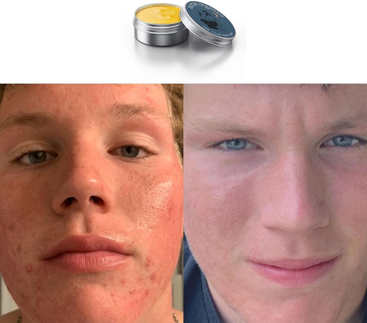 Norse Organics Acne,Norse Organics Acne & Redness Killer,Norse Organics Acne Balm,Ultra-Performance Skincare,Acne Clearing Cream for Man (2pcs) - OutsideCool