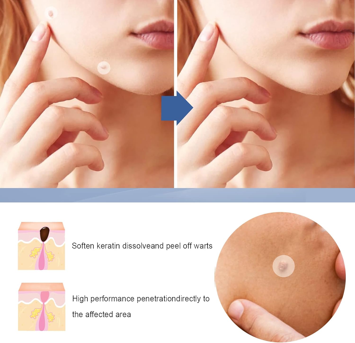 144 PCS Skin Tag Patches/New & Improved Formula Skin Tag Patche/Suitable for All Body - OutsideCool